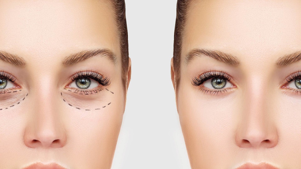 Eye Bag Removal Surgery Ireland at Leo Clemmer blog