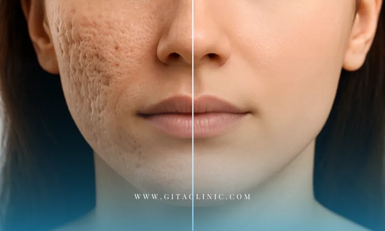 میکرونیدلینگ بهتر است یا لیزر برای جای جوش؟
