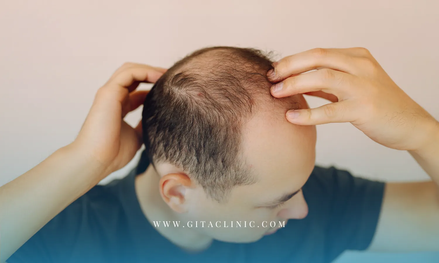 مهم‌ترین دلایل نازک شدن موی آقایان